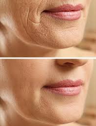 Laser Con Fraccionado imagen 2